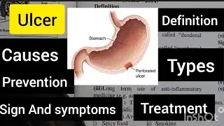 Understanding Ulcers: Types, Causes, Symptoms, Treatment, and Prevention