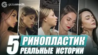 Rhinoplasty Recovery! The Truth About the Recovery Process