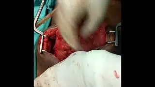 Subtotal Gastrectomy with D2 Lymphadenectomy | Roux-en-Y | Gastrojejunostomy | Dr Subhadip Sarkar