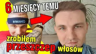 6 MISIĘCY TEMU ZROBIŁEM PRZESZCZEP WŁOSÓW   EFEKTY  VLOG ODC 3
