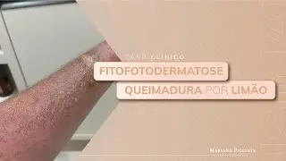 [Caso clínico] Queimadura por limão - fitofotodermatose