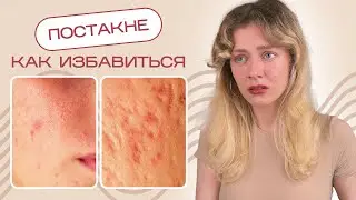 Как избавиться от ПЯТЕН и РУБЦОВ ПОСТАКНЕ навсегда