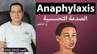 الصدمة التحسسية / anaphylaxis