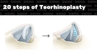20 steps of Teorhinoplasty (no sound)