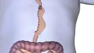 Esophagectomy Procedure Animation