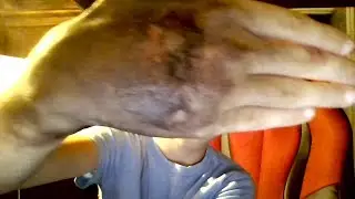 FX infected bleeding hand