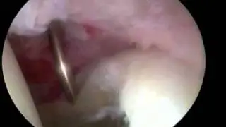 Hip Arthroscopy Labral Tear