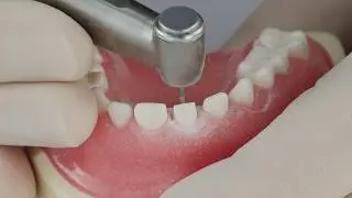 Pediatric Zirconia Crown Technique | Anterior