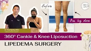 LIPEDEMA |  360° CANKLE & KNEE LIPOSUCTION | Artlipo | Expert  Dr. Thomas Su