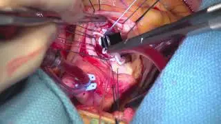 Aortic Valve Replacement  Step by Step (Step 3 of 7)