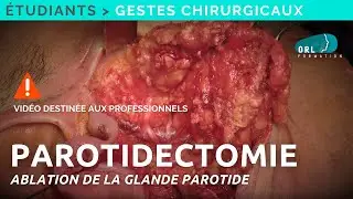 Parotidectomy | Surgical procedure