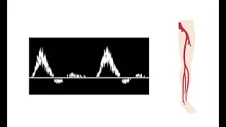 Interpreting duplex waveforms