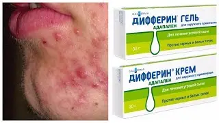 Дифферин (Адапален) - личный опыт применения, рекомендации, отзывы