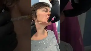 Коррекция зоны депрессии канюлей.