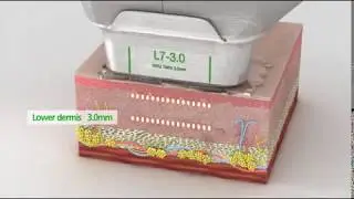 Smas-лифтинг ultraformer в Москве