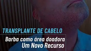 Transplante Capilar usando Barba #cabelodabarbanacabeça #transplantecapilarcombarba