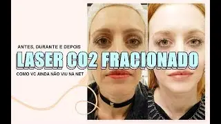 LASER CO2 FRACIONADO COMO VC AINDA NÃO VIU NA INTERNET- ANTES, DURANTE, DEPOIS...