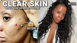 ADULT ACNE → CLEAR✨ SKINCARE ROUTINE 2023 ACNE OILY SKIN| 60 SEC DOUBLE CLEANSE Reduce 𝐓𝐄𝐗𝐔𝐑𝐄𝐃 Skin