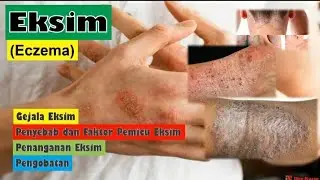 Eksim (Eczema) - Penyebab, Gejala dan Pengobatan Eksim