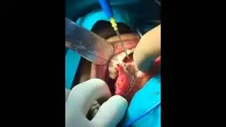 Surgery of an Early Stage of Tounge Cancer. A rare video