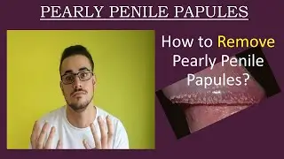 Pearly Penile Papules Treatment and Removal / White spots on Penis