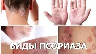 Виды псориаза