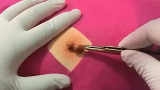 Treatment Of Blackhead Removal at Lam Dep Spa #046