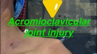 Acromioclavicular joint injury managed with loop endobutton & fibrewire #ligament #injury #shoulder
