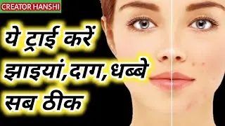 How To Get Rid Of Hyper Pigmentation -Freckles,Darkspots|Home Remedies Tips