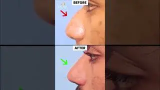 Rhinoplasty in Chennai - Nose Reshaping Surgery 