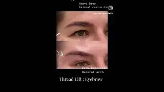 aptos thread lift for eyebrows lift #threadlift #eyebrowslift #aptos