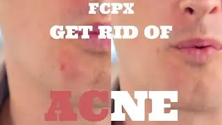 Final Cut Pro X Get Rid of Acne / Pimples