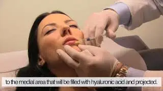 Lips injection technique with HYAcorp Lips filler