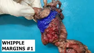 Whipple’s specimen (pancreaticoduodenectomy) margins. Part 1