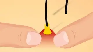 Tam Olarak Bir Sivilcenin İçinde Ne Var?  Asla Patlatmayın !