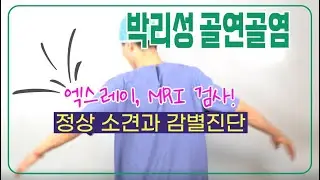 무릎 박리성골연골염4 - 엑스레이, MRI