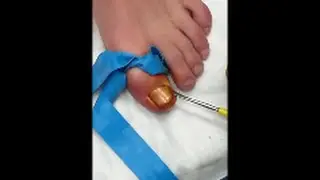 GRAPHIC: Ingrown Toenail Surgery