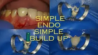 LIFE HACK postendodontic front teeth build up
