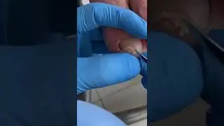 Pat 2 Painful Nails Inside skin cutting #nailout #nailscut #nailscare #naildoctor #nails #shorts