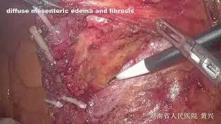 LapD3 lymph node dissection with left colic and first sigmoid arteries preservation in RC after NAT