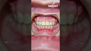 Result of gum coagulation 