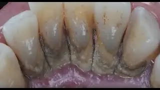 FEMALE - TARTAR REMOVAL