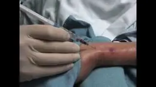 Arterial Puncture for Blood Gas Analysis NEJM