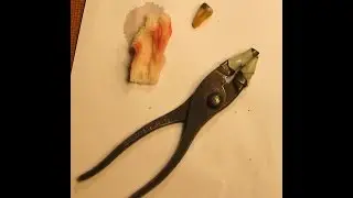 PULLING A  TOOTH OUT!