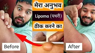 Lipoma Natural Treatment || Lipoma Exercise Treatment || Lipoma Ko Kaise Theek Karen || Lipoma Gath