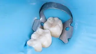 Old Amalgam filling Replacement