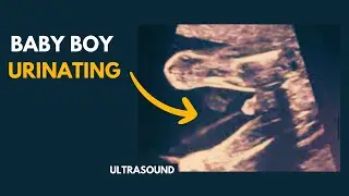 Ultrasound showing baby boy peeing ! 