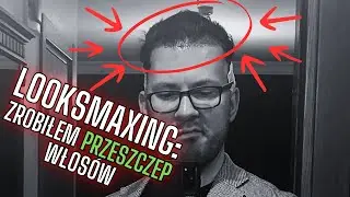 LOOKSMAXING: Zrobiłem przeszczep włosów!