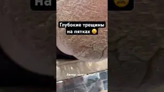 Запущенные пятки, глубокие трещины🫣 ДО/ПОСЛЕ Автор: soniya_kianiy 