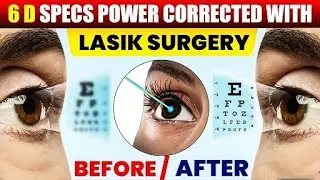 -6 D Specs Power Corrected with LASIK Surgery | Vision Eye Centre #lasik #doctor